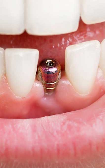 dental implant ready for crown